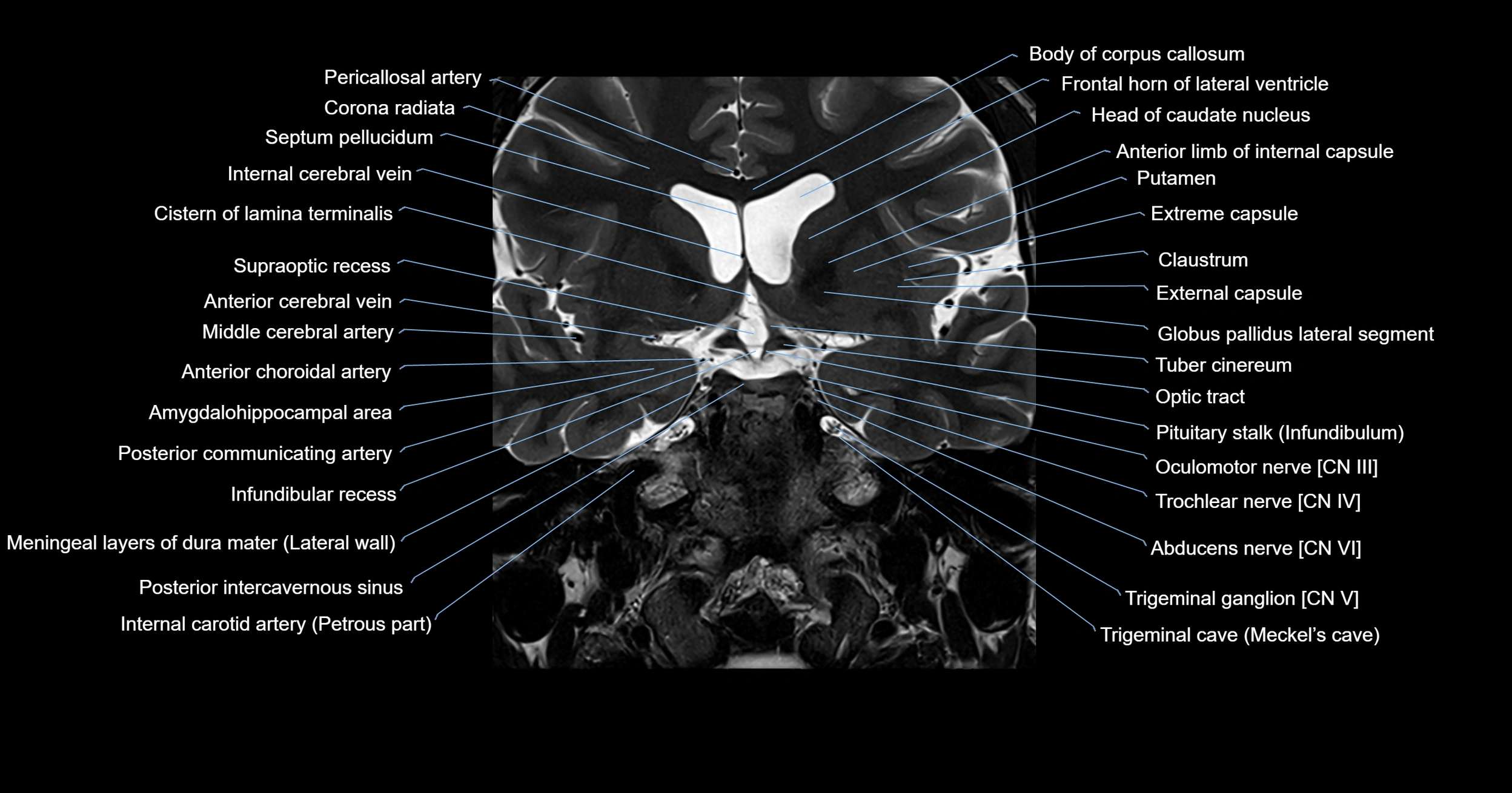 MRI brainstem & basal ganglia anatomy labelled 3T MRI images -img-00001-00014.webp